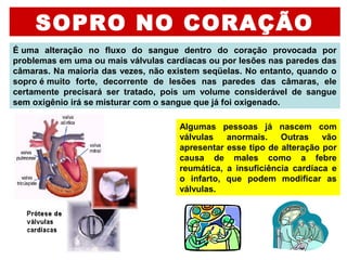 SOPRO NO CORAÇÃO
É uma  alteração  no  fluxo  do  sangue  dentro  do  coração  provocada  por 
problemas em uma ou mais válvulas cardíacas ou por lesões nas paredes das 
câmaras. Na maioria das vezes, não existem seqüelas. No entanto, quando o 
sopro é muito  forte,  decorrente  de  lesões  nas  paredes  das  câmaras,  ele 
certamente  precisará  ser  tratado,  pois  um  volume  considerável  de  sangue 
sem oxigênio irá se misturar com o sangue que já foi oxigenado. 
Algumas  pessoas  já  nascem  com 
válvulas  anormais.  Outras  vão 
apresentar esse tipo de alteração por 
causa  de  males  como  a  febre 
reumática,  a  insuficiência  cardíaca  e 
o  infarto,  que  podem  modificar  as 
válvulas. 
 