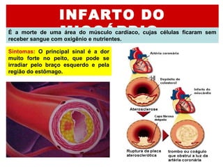 INFARTO DO
MIOCÁRDIOÉ  a  morte  de  uma  área  do  músculo  cardíaco,  cujas  células  ficaram  sem 
receber sangue com oxigênio e nutrientes.
Sintomas:  O  principal  sinal  é  a  dor 
muito  forte  no  peito,  que  pode  se 
irradiar  pelo  braço  esquerdo  e  pela 
região do estômago.
 