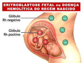 ERITROBLASTOSE FETAL ou DOENÇA
HEMOLÍTICA DO RECÉM NASCIDO
 