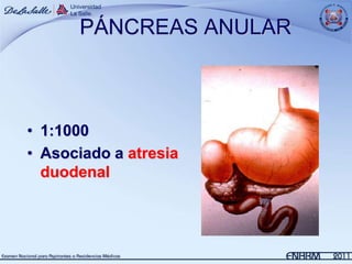 PÁNCREAS ANULAR



• 1:1000
• Asociado a atresia
  duodenal
 