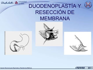 DUODENOPLASTÍA Y
  RESECCIÓN DE
   MEMBRANA
 