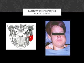 PATHWAY OF SPREAD FOR
    BUCCAL SPACE
 