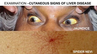 EXAMINATION –CUTANEOUS SIGNS OF LIVER DISEASE
JAUNDICE
SPIDER NEVI
 