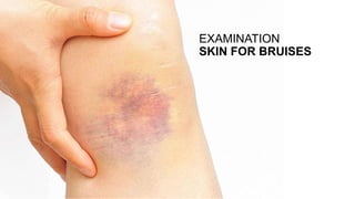 EXAMINATION
SKIN FOR BRUISES
 