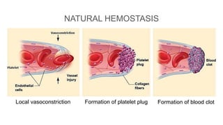 NATURAL HEMOSTASIS
Local vasoconstriction Formation of platelet plug Formation of blood clot
 