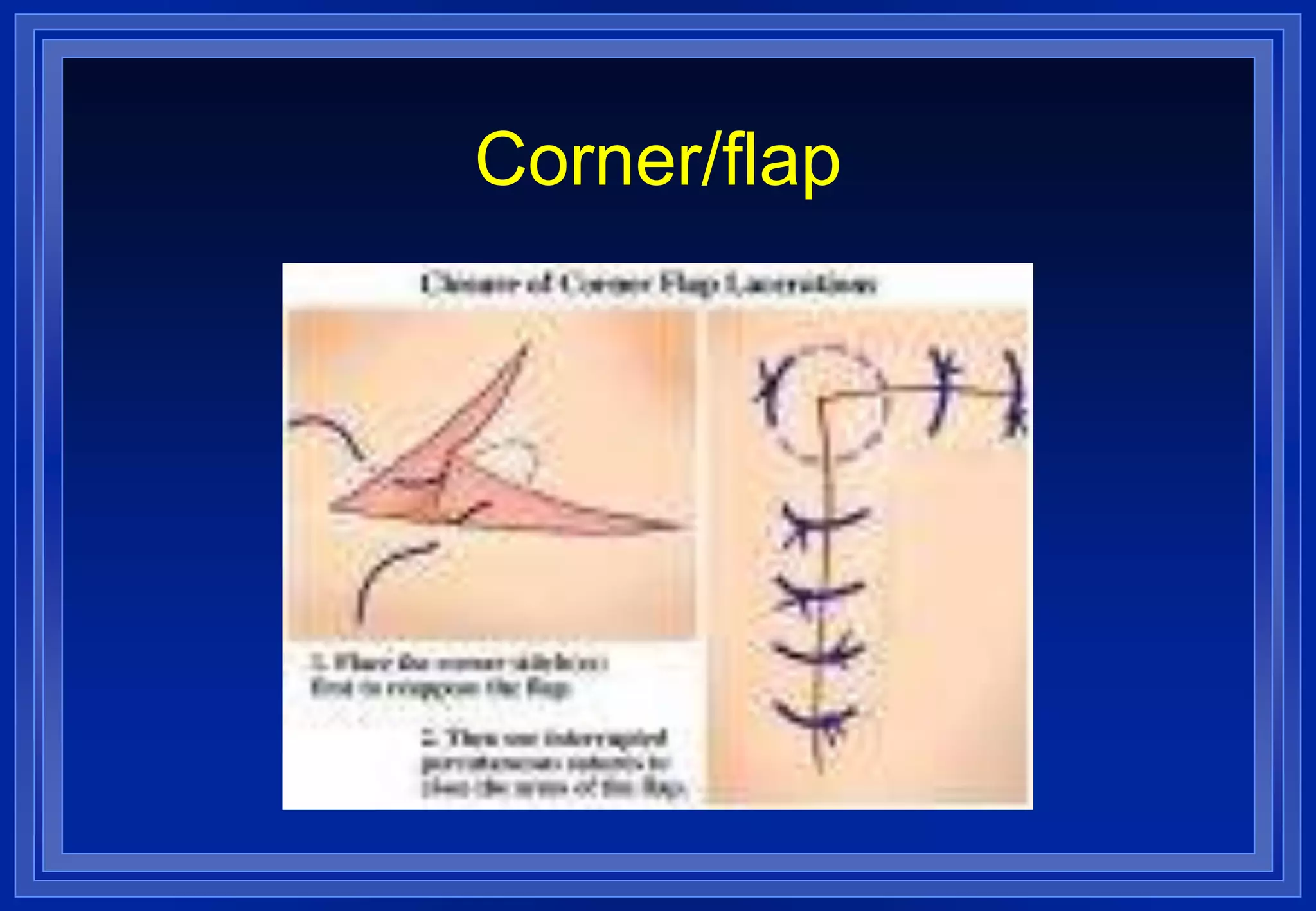 SUTURE PATTERNS.ppt