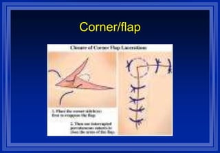 Suturing Patterns SUTURE PATTERNS.ppt