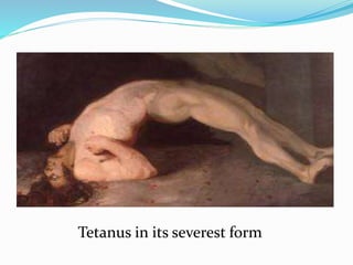 Tetanus in its severest form
 