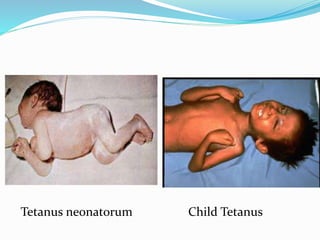 Tetanus neonatorum Child Tetanus
 