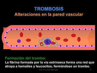 TROMBOSIS Alteraciones en la pared vascular Formación del trombo: La fibrina formada por la vía extrínseca forma una red que atrapa a hematíes y leucocitos, formándose un trombo. Jesús A. Custodio Marroquín 