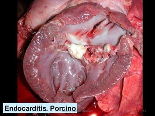 Endocarditis. Porcino Jesús A. Custodio Marroquín 