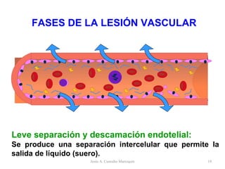 FASES DE LA LESIÓN VASCULAR Leve separación y descamación endotelial: Se produce una separación intercelular que permite la salida de líquido (suero). Jesús A. Custodio Marroquín 