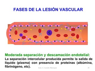 FASES DE LA LESIÓN VASCULAR Moderada separación y descamación endotelial: La separación intercelular producida permite la salida de líquido (plasma) con presencia de proteínas (albúmina, fibrinógeno, etc). Jesús A. Custodio Marroquín 