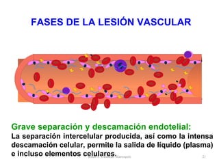 FASES DE LA LESIÓN VASCULAR Grave separación y descamación endotelial: La separación intercelular producida, así como la intensa descamación celular, permite la salida de líquido (plasma) e incluso elementos celulares. Jesús A. Custodio Marroquín 
