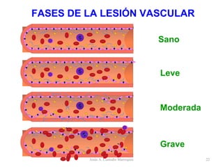 FASES DE LA LESIÓN VASCULAR Grave Moderada Leve Sano Jesús A. Custodio Marroquín 