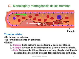 Trombo mixto: - Se forman en arterias. - Se forma lentamente en el tiempo. -  Partes : a.-  Cabeza:  Es lo primero que se forma y suele ser blanca. b.-  Cuerpo:  A veces es estriado (blanco y rojo) o no se aprecia. c.-  Cola:  Se forma la última. Siempre es roja, blanda y fácilmente  desprendible (no unida al vaso) desencadenando émbolos. C.-  Morfología y morfogénesis de los trombos Jesús A. Custodio Marroquín a b c Émbolo 