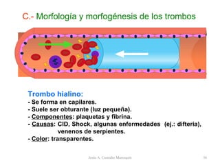 Trombo hialino: - Se forma en capilares. - Suele ser obturante (luz pequeña). -  Componentes : plaquetas y fibrina. -  Causas : CID, Shock, algunas enfermedades  (ej.: difteria),  venenos de serpientes. -  Color : transparentes. C.-  Morfología y morfogénesis de los trombos Jesús A. Custodio Marroquín 