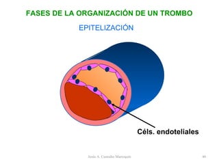 EPITELIZACIÓN Céls. endoteliales FASES DE LA ORGANIZACIÓN DE UN TROMBO Jesús A. Custodio Marroquín 