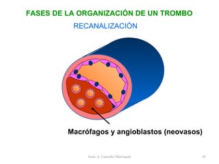 RECANALIZACIÓN Macrófagos y angioblastos (neovasos) FASES DE LA ORGANIZACIÓN DE UN TROMBO Jesús A. Custodio Marroquín 