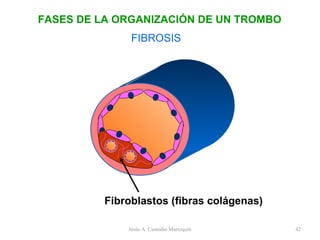 FIBROSIS Fibroblastos (fibras colágenas) FASES DE LA ORGANIZACIÓN DE UN TROMBO Jesús A. Custodio Marroquín 