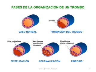 FASES DE LA ORGANIZACIÓN DE UN TROMBO VASO NORMAL FORMACIÓN DEL TROMBO EPITELIZACIÓN RECANALIZACIÓN FIBROSIS Trombo Céls. endoteliales Macrófagos y  angioblastos (neovasos) Fibroblastos  (fibras colágenas) Jesús A. Custodio Marroquín 