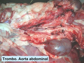 Trombo. Aorta abdominal Jesús A. Custodio Marroquín 