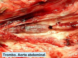 Trombo. Aorta abdominal Jesús A. Custodio Marroquín 