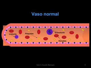 Vaso normal Jesús A. Custodio Marroquín Hematíes Granulocito Plaquetas Linfocito 
