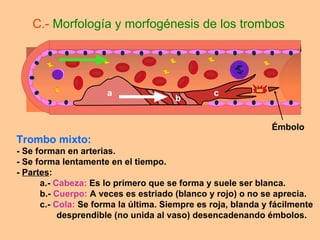 Trombo mixto: - Se forman en arterias. - Se forma lentamente en el tiempo. -  Partes : a.-  Cabeza:  Es lo primero que se forma y suele ser blanca. b.-  Cuerpo:  A veces es estriado (blanco y rojo) o no se aprecia. c.-  Cola:  Se forma la última. Siempre es roja, blanda y fácilmente  desprendible (no unida al vaso) desencadenando émbolos. C.-  Morfología y morfogénesis de los trombos a b c Émbolo 