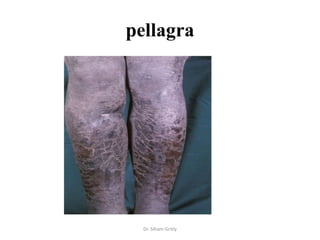 pellagra




  Dr. Siham Gritly
 