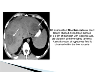 CT examination: Unenhanced axial scan:
Round-shaped, hypodense masses
of 5-6 cm of diameter, with isodense wall,
are visible in both liver lobes (arrows).
A small amount of hypodense fluid is
observed within the liver capsule
 
