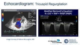 Tr Jet Rvsp Comprehensive Diagnosis and Management of Pulmonary Arterial ...