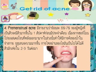 4. Premenstrual acne มีรายงานว่าร้อยละ 60-70 ของผู้หญิงที่
เป็นสิวจะมีสิวมากขึ้นใน 1 สัปดาห์ก่อนมีประจาเดือน เนื่องจากฮอร์โมน
โปรเจสเตอโรนที่หลั่งออกมามากในช่วงนั้นทาให้มีการคั่งของน้าใน
ร่างกาย รูขุมขนจะบวมมากขึ้น การไหลผ่านของไขมันเป็นไปได้ไม่ดี
สิวมักเห่อใน 2-3 วันต่อมา
menu
 