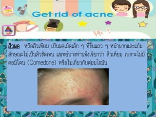 สิวผด หรือสิวเทียม เป็นผดเม็ดเล็ก ๆ ที่ขึ้นแถว ๆ หน้าผากและแก้ม
ลักษณะไม่เป็นสิวชัดเจน แพทย์บางท่านจึงเรียกว่า สิวเทียม เพราะไม่มี
คอมิโดน (Comedone) หรือไม่เกี่ยวกับต่อมไขมัน
menu
 