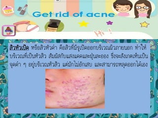 สิวหัวเปิด หรือสิวหัวดา คือสิวที่มีรูเปิดออกบริเวณผิวภายนอก ทาให้
บริเวณที่เป็นหัวสิว สัมผัสกับแสงแดดและฝุ่นละออง ซึ่งจะสังเกตเห็นเป็น
จุดดา ๆ อยู่บริเวณหัวสิว แต่มักไม่อักเสบ และสามารถหลุดออกได้เอง
menu
 