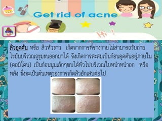 สิวอุดตัน หรือ สิวหัวขาว เกิดจากการที่ร่างกายไม่สามารถขับถ่าย
ไขมันบริเวณรูขุมขนออกมาได้ จึงเกิดการสะสมเป็นก้อนอุดตันอยู่ภายใน
(คอมิโดน) เป็นก้อนนูนเล็กๆพบได้ทั่วไปบริเวณใบหน้าหน้าอก หรือ
หลัง ซึ่งจะเป็นต้นเหตุของการเกิดสิวอักเสบต่อไป
menu
 