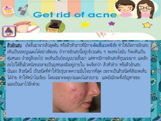 สิวอักเสบ เกิดขึ้นมาจากสิวอุดตัน หรือสิวหัวขาวที่มีการติดเชื้อแบคทีเรีย ทาให้เกิดการอักเสบ
เห็นเป็นรอยนูนแดงได้อย่างชัดเจน ถ้าการอักเสบนี้อยู่บริเวณต้น ๆ ของท่อไขมัน ก็จะเห็นเป็น
ตุ่มหนอง ถ้าอยู่ลึกลงไป จะเห็นเป็นก้อนนูนบวมขึ้นมา แต่หากมีการอักเสบที่รุนแรงมาก และลึก
ลงไปใต้ชั้นผิวหนังจนกลายเป็นถุงหนองฝังอยู่ภายใน จะเรียกว่า สิวหัวช้าง หรือสิวอักเสบ
นั่นเอง สิวชนิดนี้ เป็นชนิดที่ทาให้วัยรุ่นขาดความมั่นใจมากที่สุด เพราะเป็นสิวชนิดที่สังเกตเห็น
ได้ง่าย ทาให้หน้าไม่เรียบ โดยเฉพาะจะดูบวมแดงไม่สวยงาม และยังมักจะทิ้งปัญหารอย
แผลเป็นเอาไว้อีกด้วย
menu
 