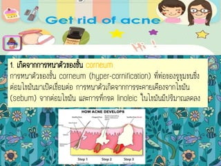 1. เกิดจากการหนาตัวของชั้น corneum
การหนาตัวของชั้น corneum (hyper-cornification) ที่ท่อของรูขุมขนซึ่ง
ต่อมไขมันมาเปิดเชื่อมต่อ การหนาตัวเกิดจากการระคายเคืองจากไขมัน
(sebum) จากต่อมไขมัน และการที่กรด linoleic ในไขมันมีปริมาณลดลง
menu
 