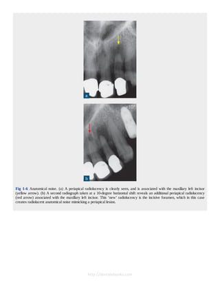 Cone Beam Computed Tomography in Endodontics 1º Edición Edition Shanon ...
