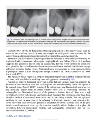 Cone Beam Computed Tomography in Endodontics 1º Edición Edition Shanon ...