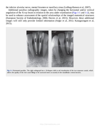 Cone Beam Computed Tomography in Endodontics 1º Edición Edition Shanon ...