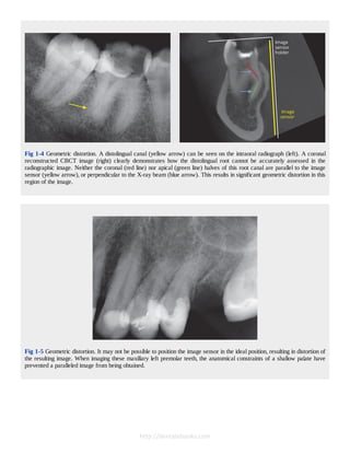 Cone Beam Computed Tomography in Endodontics 1º Edición Edition Shanon ...