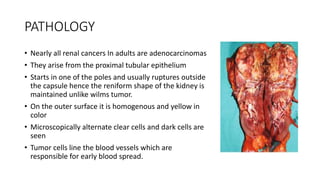 PATHOLOGY
• Nearly all renal cancers In adults are adenocarcinomas
• They arise from the proximal tubular epithelium
• Starts in one of the poles and usually ruptures outside
the capsule hence the reniform shape of the kidney is
maintained unlike wilms tumor.
• On the outer surface it is homogenous and yellow in
color
• Microscopically alternate clear cells and dark cells are
seen
• Tumor cells line the blood vessels which are
responsible for early blood spread.
 