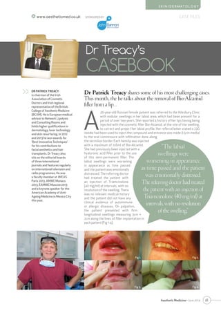 61
CASE FILES
Aesthetic Medicine • June 2014
S K I N / D E R M AT O L O G Y
www.aestheticmed.co.uk
Dr Patrick Treacy shares some of his most challenging cases.
This month, the he talks about the removal of Bio-Alcamid
filler from a lip…
Dr Treacy’s
CASEBOOK
DR PATRICK TREACY
is chairman of the Irish
Association of Cosmetic
Doctors and Irish regional
representative of the British
College of Aesthetic Medicine
(BCAM). He is European medical
advisor to Network Lipolysis
and Consulting Rooms and
holds higher qualifications in
dermatology, laser technology
and skin resurfacing. In 2012
and 2013 he won awards for
‘Best Innovative Techniques’
for his contributions to
facial aesthetics and hair
transplants. Dr Treacy also
sits on the editorial boards
of three international
journals and features regularly
on international television and
radio programmes. He was
a faculty member at IMCAS
Paris 2013, AMWC Monaco
2013, EAMWC Moscow 2013
and a keynote speaker for the
American Academy of Anti-
Ageing Medicine in Mexico City
this year.
>>
SPONSORED BY
A
20-year-old Russian female patient was referred to the Ailesbury Clinic
with nodular swellings in her labial area, which had been present for a
period of over two years. She reported a history of her lips having being
injected with the cosmetic filler Bio-Alcamid, at the site of the swelling,
to correct and project her labial profile. Her referral letter stated a 23G
needle had been used to inject the compound and entrance was made 0.5cm medial
to the oral commissure with infiltration done along
the vermilion border. Each hemilip was injected
with a maximum of 0.6ml of Bio-Alcamid.
She had previously been injected with a
hyaluronic acid filler prior to the use
of this semi-permanent filler. The
labial swellings were worsening
in appearance as time passed
and the patient was emotionally
distressed. The referring doctor
had treated the patient with
an injection of Triamcinolone
(40 mg/ml) at intervals, with no
resolution of the swelling. There
was no relevant medical history
and the patient did not have any
clinical evidence of autoimmune
or allergic diseases. On palpation,
the patient presented with firm
longitudinal swellings measuring 3cm ×
2cm along the lines of filler implantation in
each patient (Fig 1-4).
“The labial
swellings were
worsening in appearance
as time passed and the patient
was emotionally distressed.
Thereferringdoctorhadtreated
thepatientwithaninjectionof
Triamcinolone(40mg/ml)at
intervals,withnoresolution
oftheswelling.”
Fig 1.
Fig 3. Fig 4.
Fig 2.
 