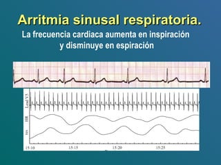 Arritmia sinusal respiratoria.Arritmia sinusal respiratoria.
La frecuencia cardiaca aumenta en inspiración
y disminuye en espiración
 
