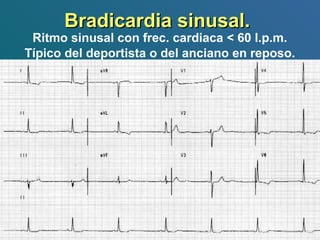 Bradicardia sinusal.Bradicardia sinusal.
Ritmo sinusal con frec. cardiaca < 60 l.p.m.
Típico del deportista o del anciano en reposo.
 