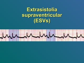 ExtrasistoliaExtrasistolia
supraventricularsupraventricular
(ESVs)(ESVs)
 