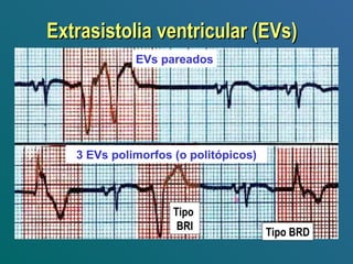 EVs pareados
3 EVs polimorfos (o politópicos)
Tipo BRD
Tipo
BRI
Extrasistolia ventricular (EVs)Extrasistolia ventricular (EVs)
 