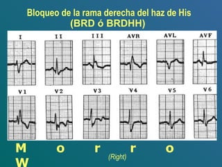 Bloqueo de la rama derecha del haz de His
(BRD ó BRDHH)
M o r r o
(Right)
 