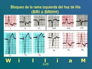 Bloqueo de la rama izquierda del haz de His
(BRI ó BRIHH)
W i l l i a M
(Left)
 